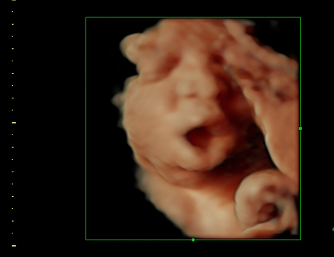 3D ultrasound image at 30 weeks
